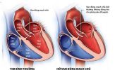 Hở van động mạch chủ có cần mổ ?