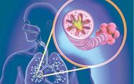 Tại sao nên cải thiện bệnh COPD bằng thảo dược?
