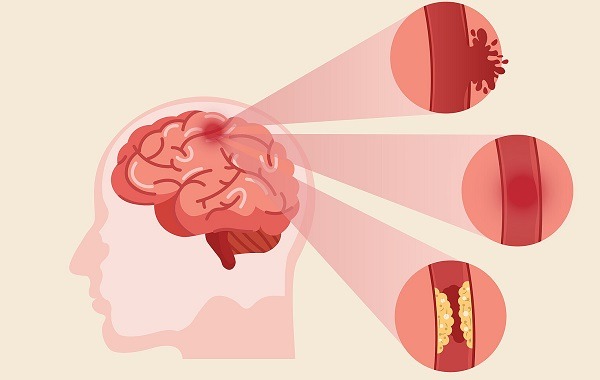 Tai biến mạch máu não(đột quỵ):Nguyên nhân, dấu hiệu nhận biết...